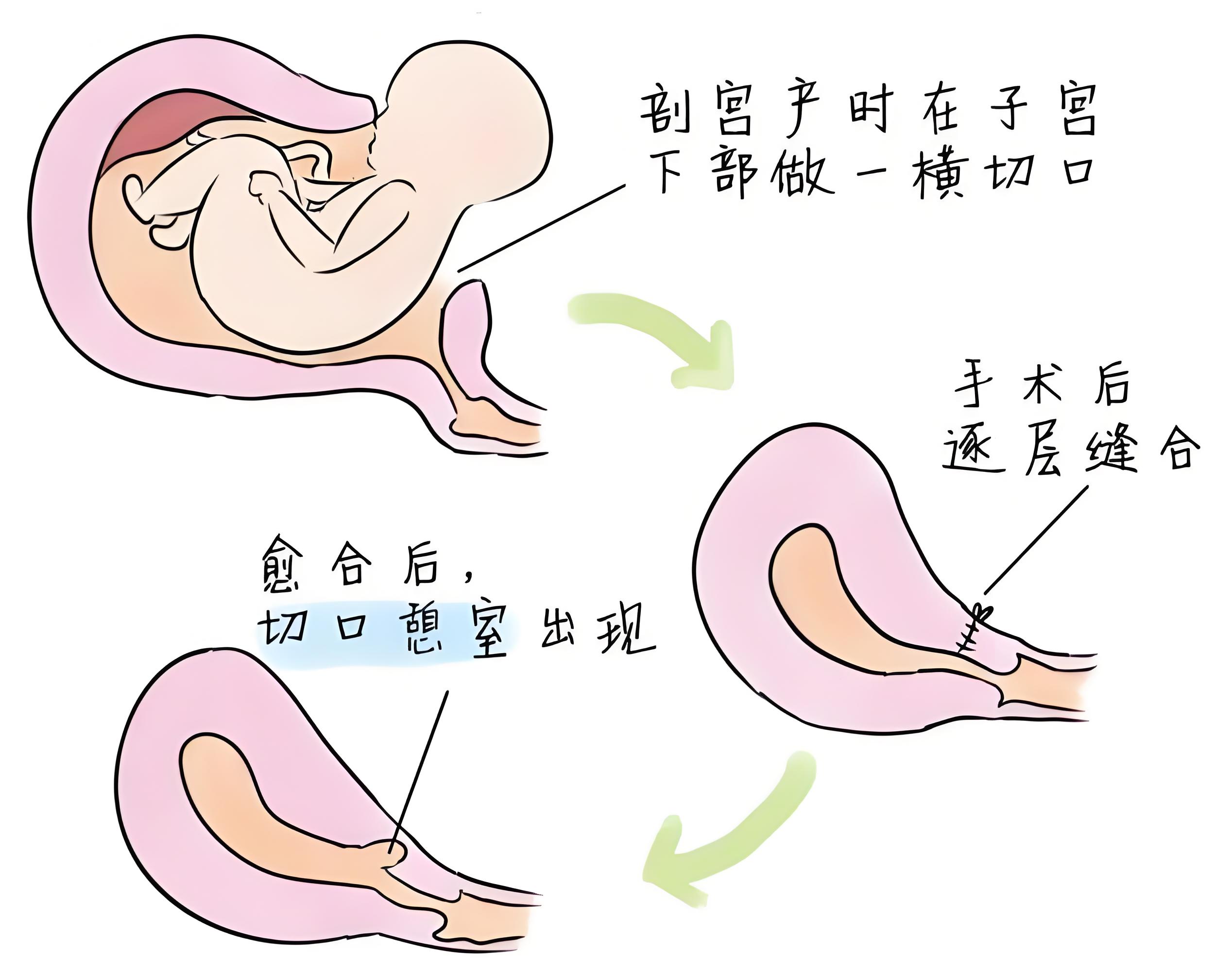 剖宫产术后月经淋漓不尽、二三胎备孕难，原来是子宫瘢痕憩室在作祟！